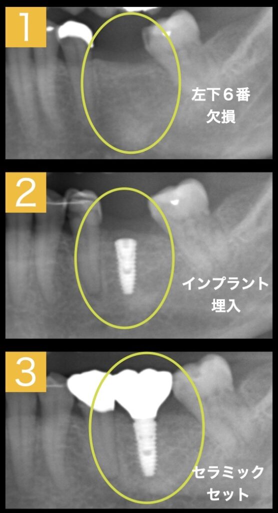 インプラント埋入までの経緯