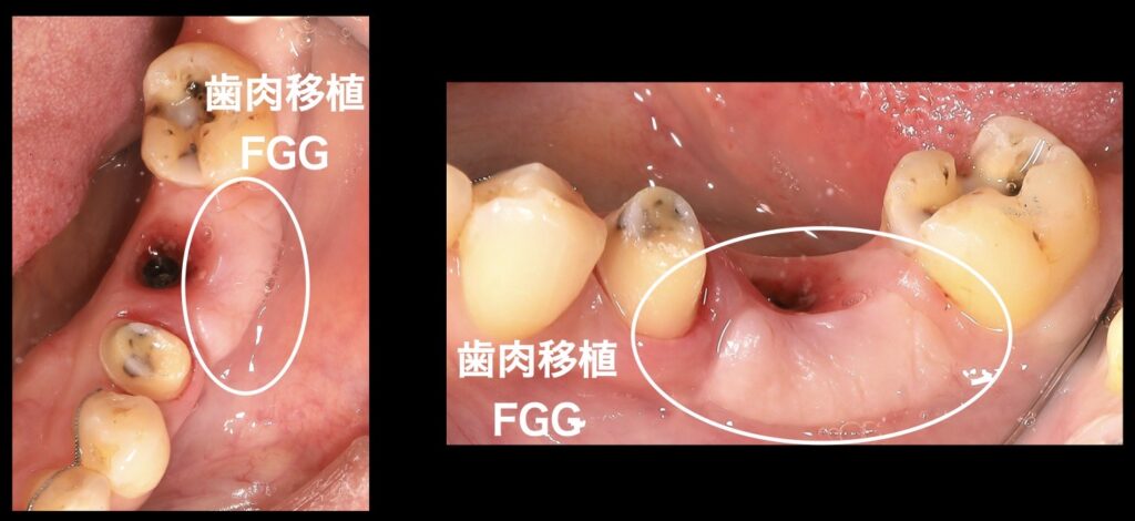 インプラントの周辺の歯肉移植
