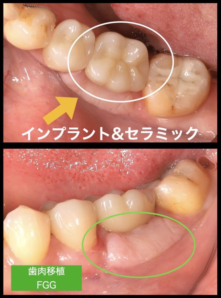 インプラント&セラミッククラウンセット