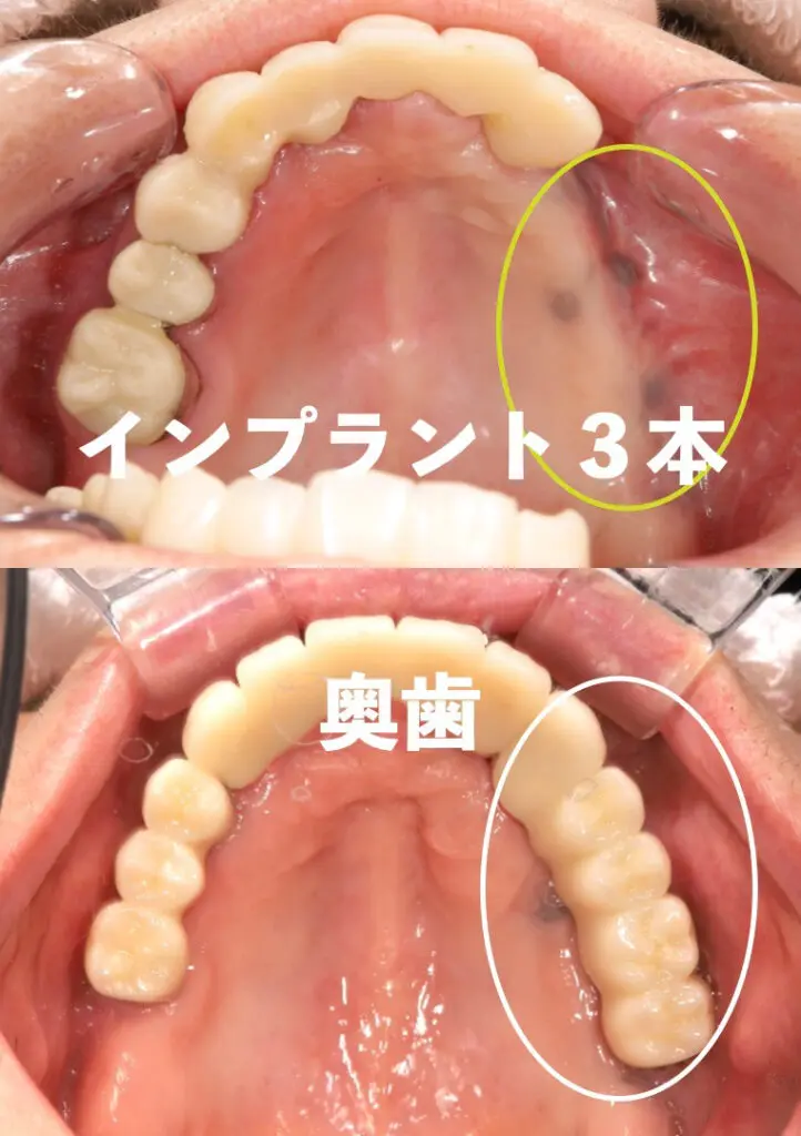 左上奥歯にインプラント3本埋入、被せ物5本で噛めるようになった症例)