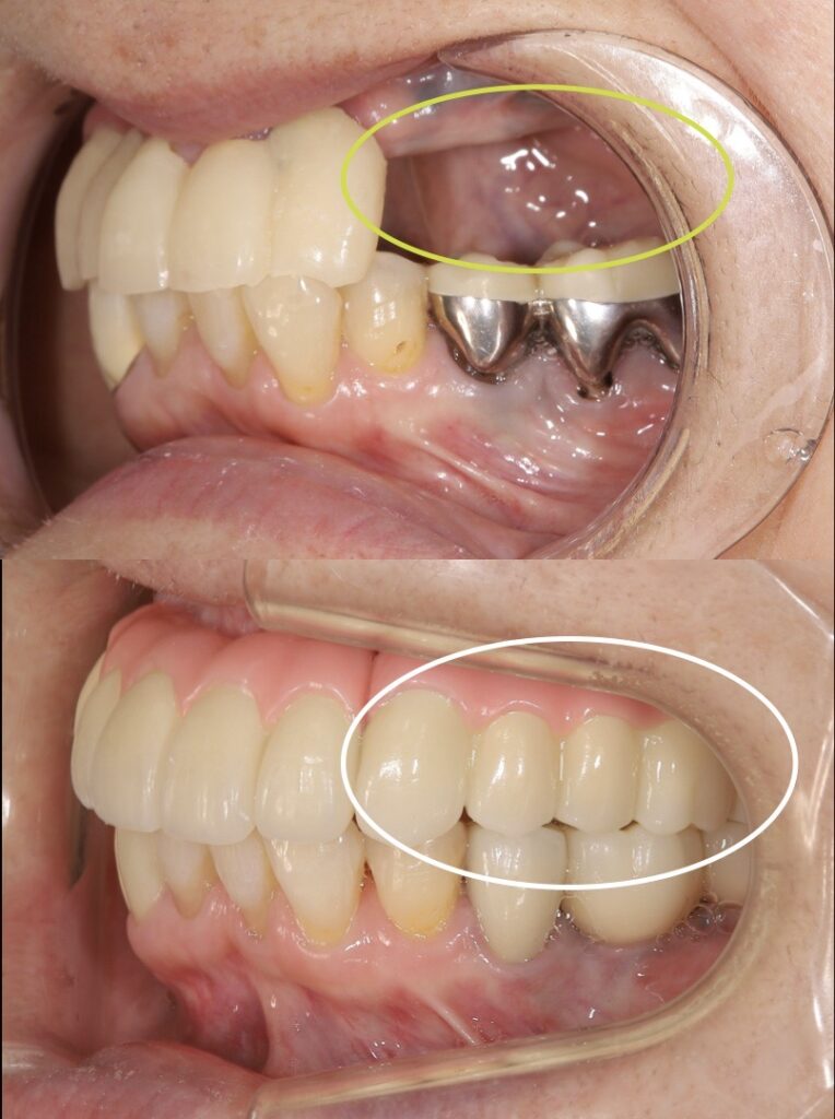 治療前後の横から見た写真