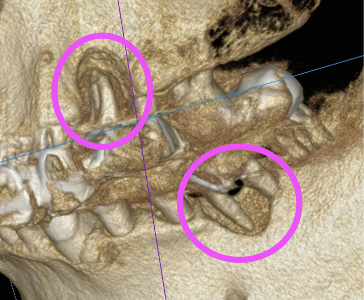 歯周病手遅れの症状　その３　『歯が上下に動く』
