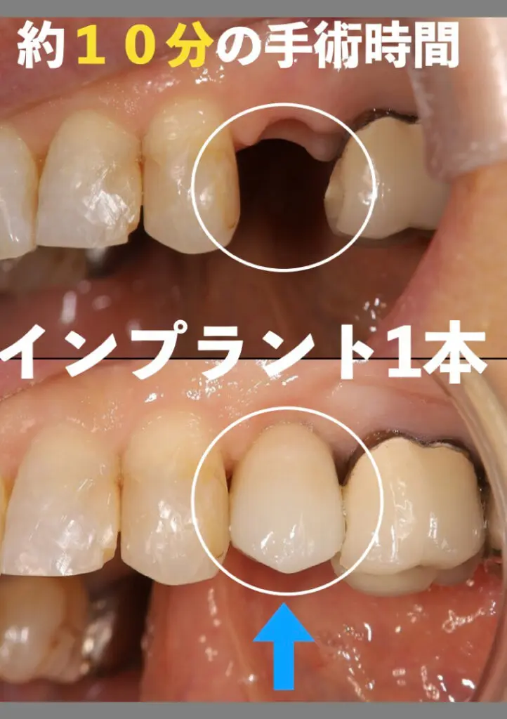 ①左上奥歯に1本インプラントを約10分で埋入した症例→痛み極小化
