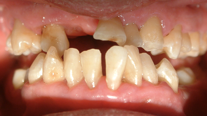 歯周病手遅れの症状　その４　『歯並びがバラバラになってきた』