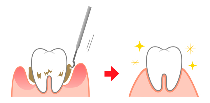 ステップ２　歯茎の中の歯石とり　（SRPルートプレーニング）