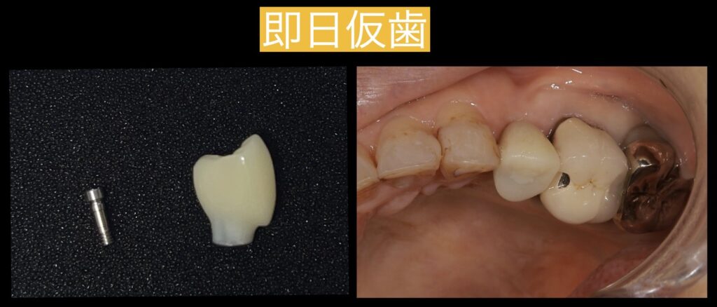 手術の後にすぐに仮歯が入ります!