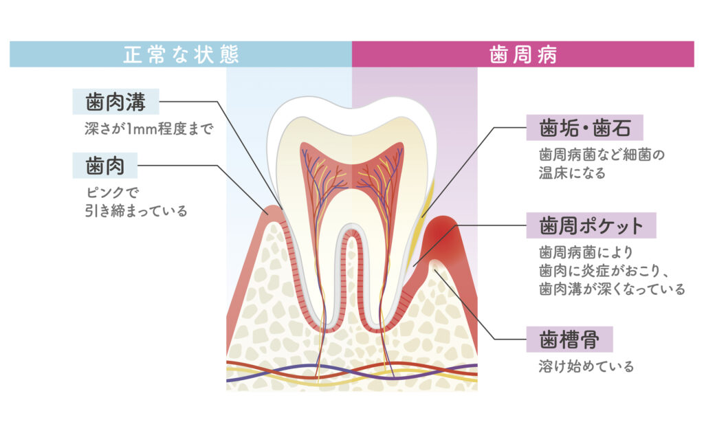 そもそも歯周病とは？
