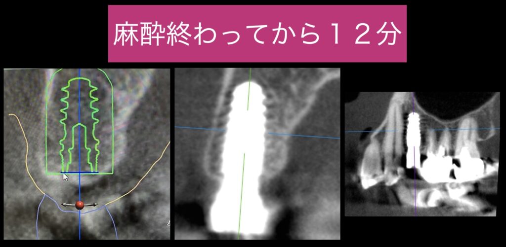 手術の時間が約10分