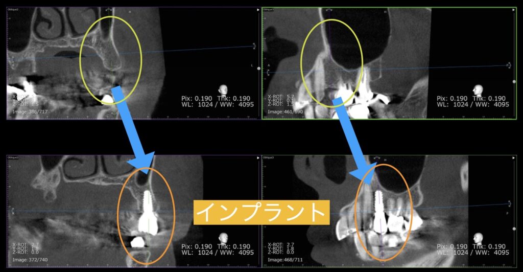 CT画像での確認
